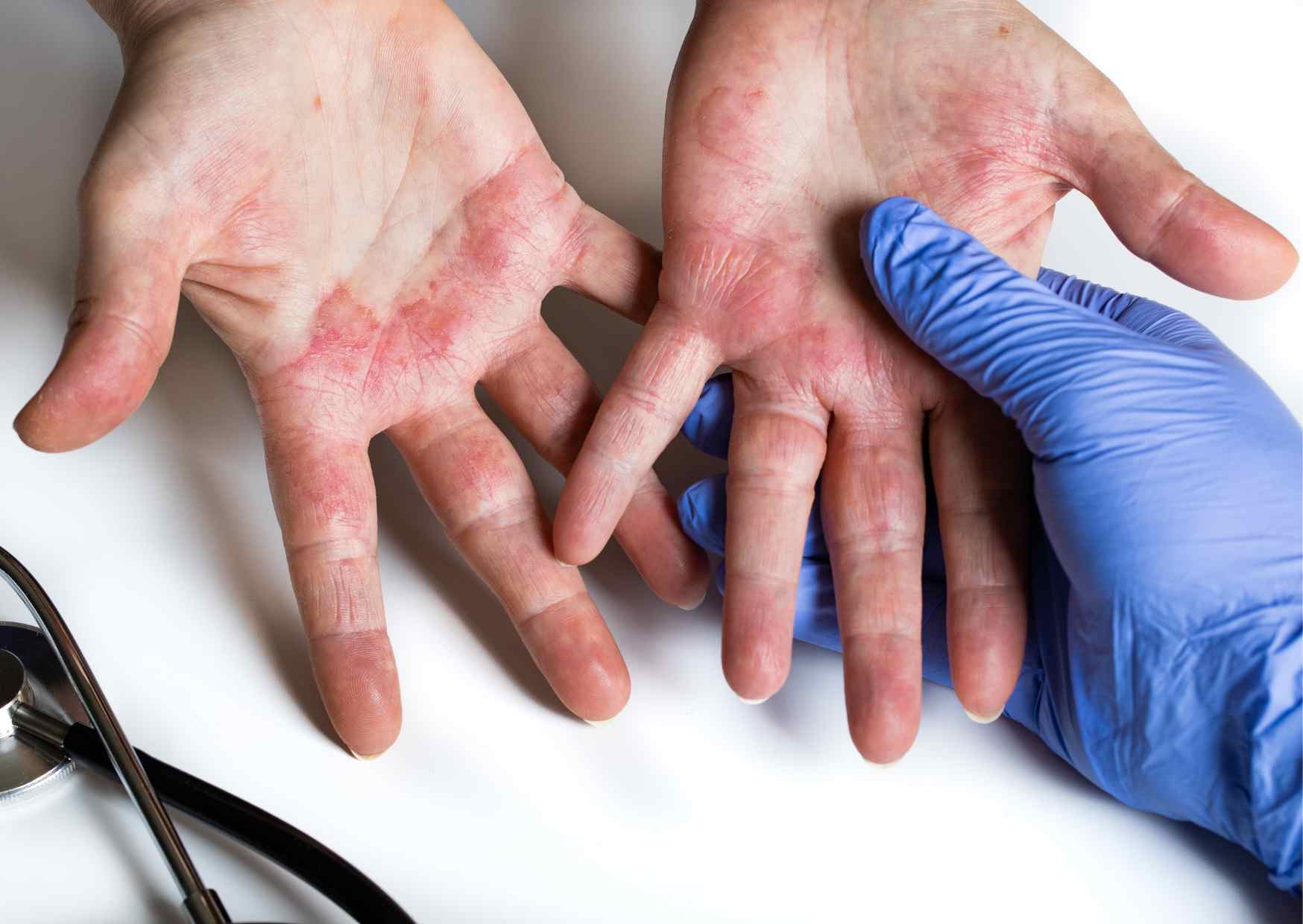 World Allergy Day: Spotlight on Atopic Dermatitis and the Emerging Role of Oligo Fucoidan